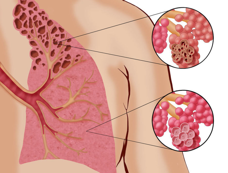 alvéoles détruites, conséquence de la maladie respiratoire - l'emphysème