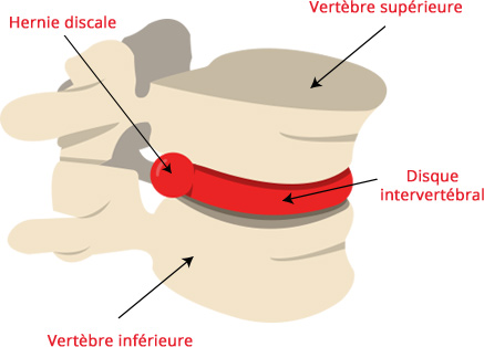 Hernie discale en image